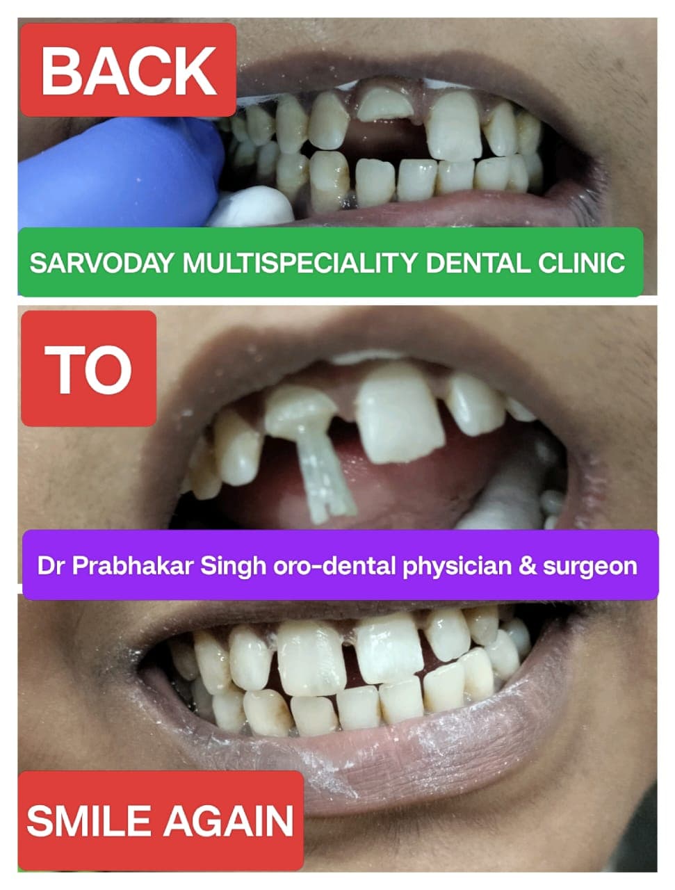Teeth Whitening