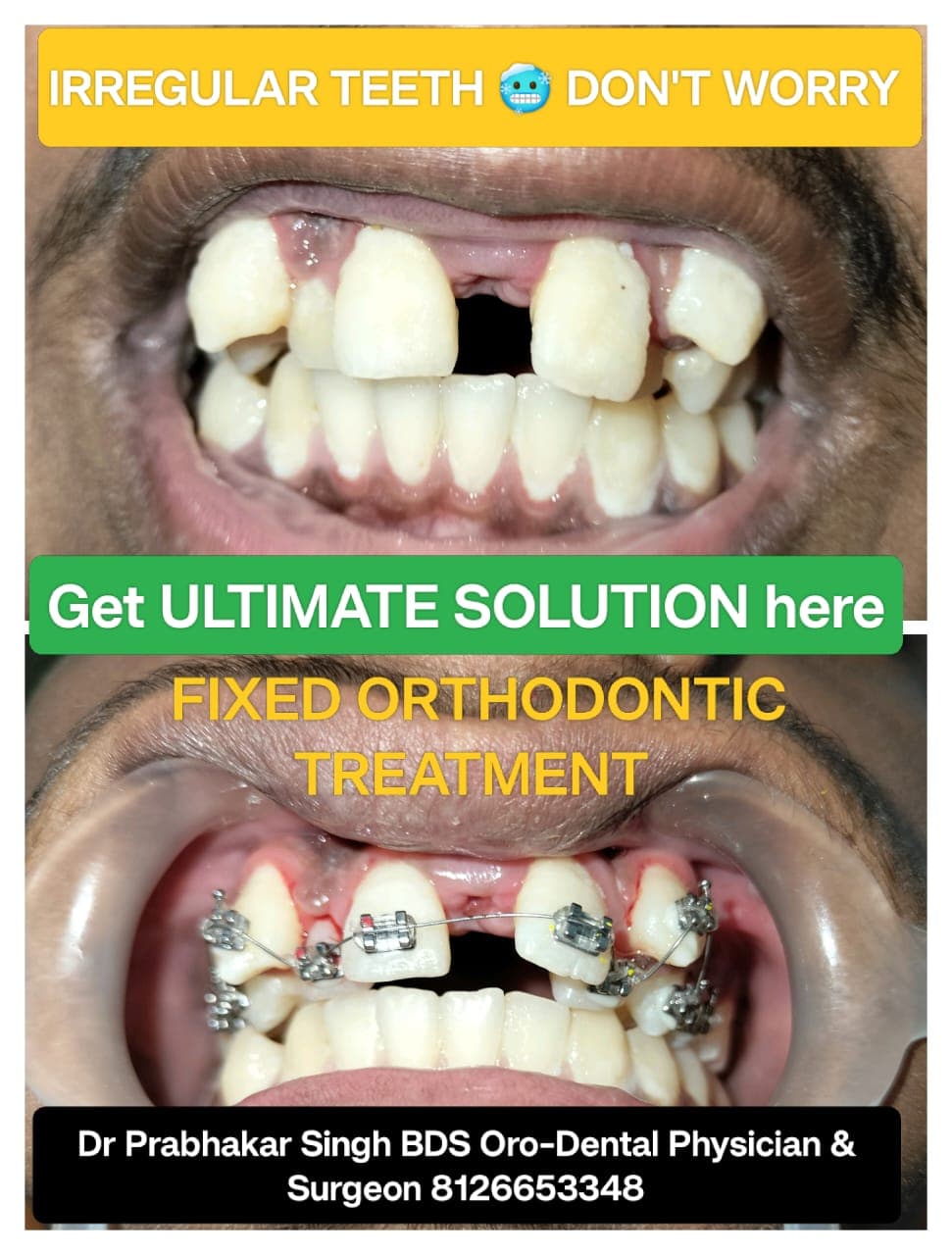 Teeth Whitening